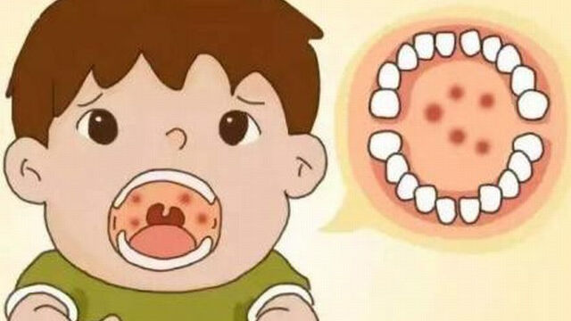 什么是疱疹性咽峡炎