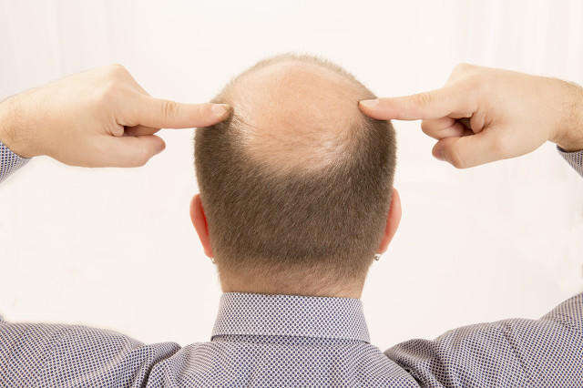 秃顶青年有救了？基因改造毛发干细胞了解一下